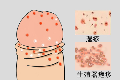 生殖器上起皮疹图片