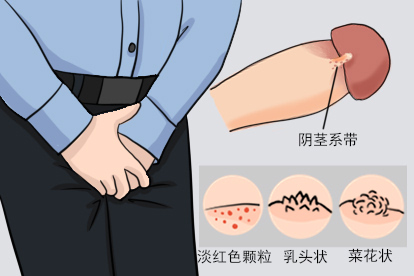 阴茎系带尖锐湿疣图