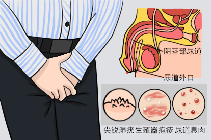 尿道下面长了小疙瘩图片