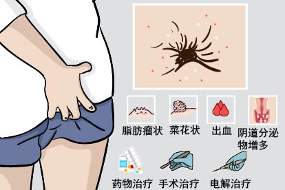 肛门尖锐湿疣图