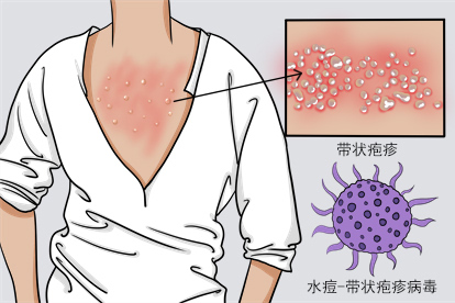 胸前带状疱疹图片