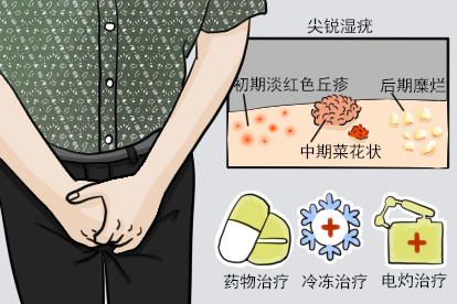 男菜花状尖锐湿疣症状图