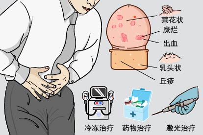 男性尖锐湿疣图