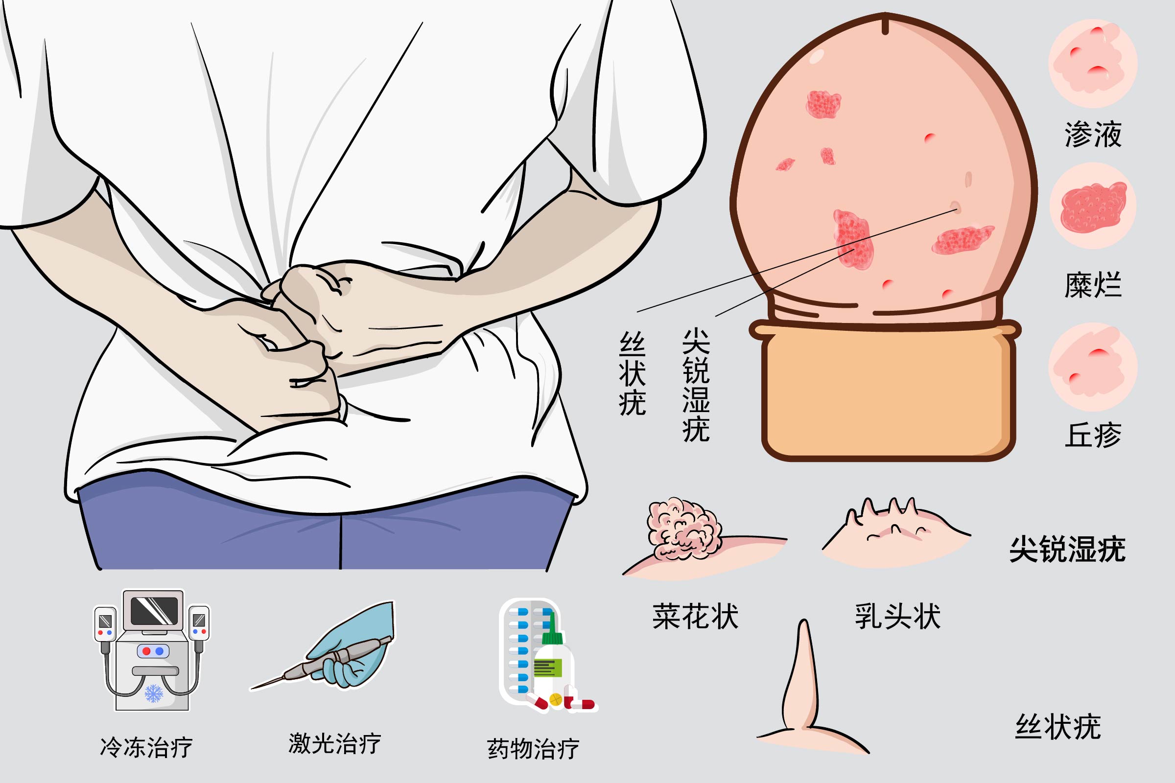 男性尖锐湿疣和丝状疣图片