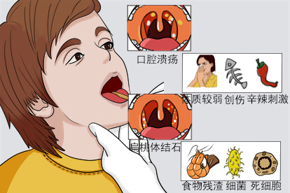 腭舌弓有小白点图片