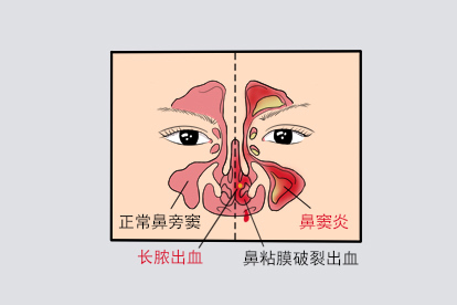 鼻窦炎鼻子里面长脓出血图