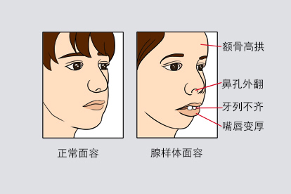 腺样体面容图片