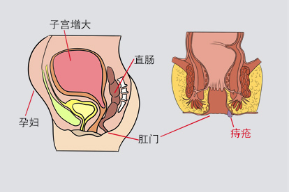 孕妇长痔图片
