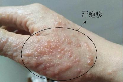 汗疱疹图片