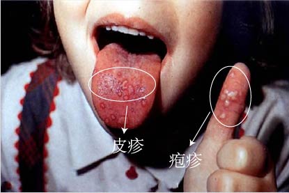 手足口病图片