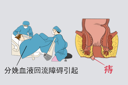 产后长痔图片