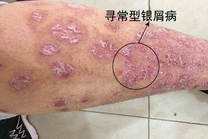 寻常型银屑病图