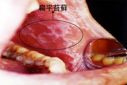 扁平苔藓图