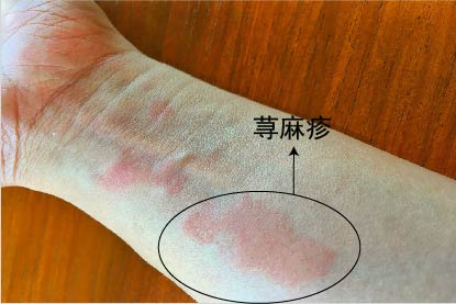 荨麻疹图