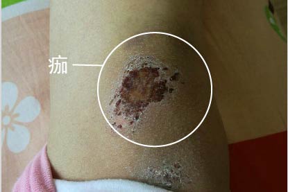 痂图片