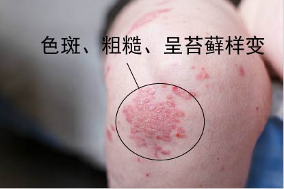 腿部慢性湿疹图片
