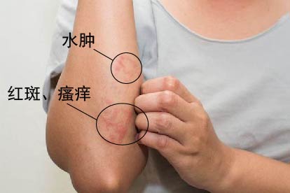 湿疹症状图片