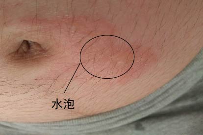 烫伤图片