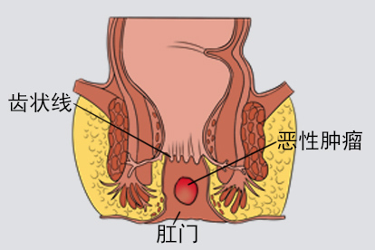 肛门周围恶性肿瘤图
