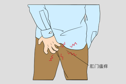 肛门周围恶性肿瘤早期症状图