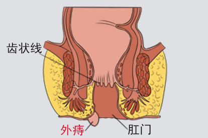 外痔图片