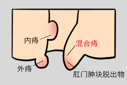混合痔的肛门肿块脱出物图
