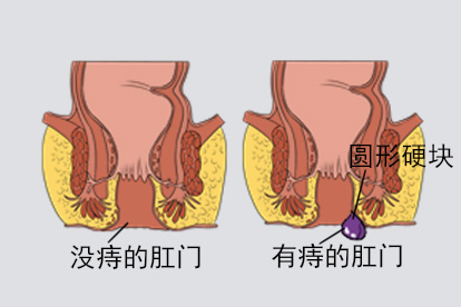 有痔和没痔的肛门图片