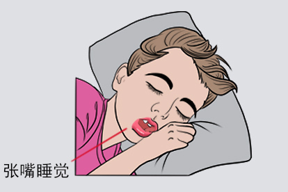 腺样体中度肥大张嘴睡觉图片