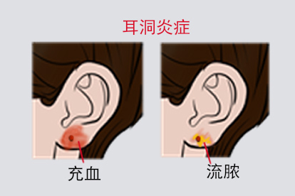 耳洞发炎图片