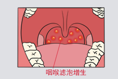 咽喉滤泡增生图片