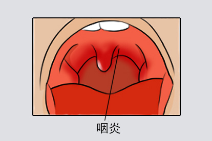 咽炎图片