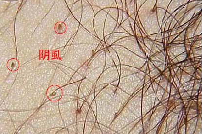 阴虱图片