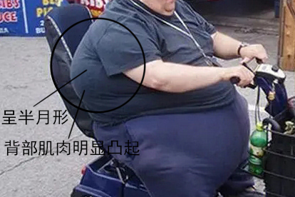 水牛背患者背部肌肉凸起图片