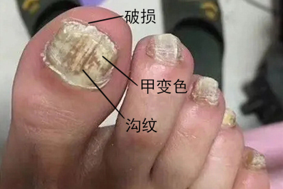 中度甲癣图片
