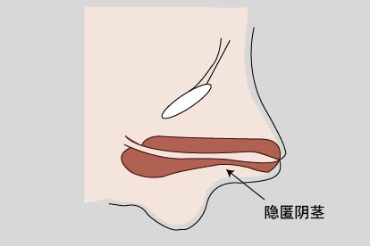 隐匿阴茎图片