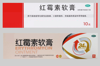 脸上长癣脂溢性皮炎治疗药物图