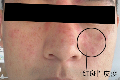 脸上长癣脂溢性皮炎原因图片