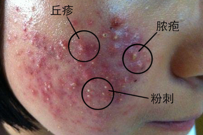 寻常痤疮症状图