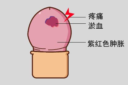 龟头擦伤图片