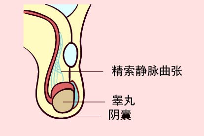精索静脉曲张位置图