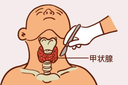 甲状腺手术切除甲状腺组织图片