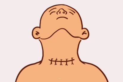 甲状腺手术全过程缝合伤口图片