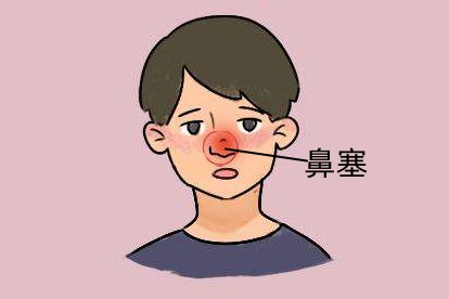 鼻窦炎引起鼻塞图