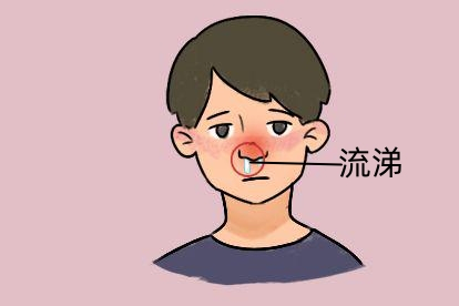 鼻窦炎引起流涕图