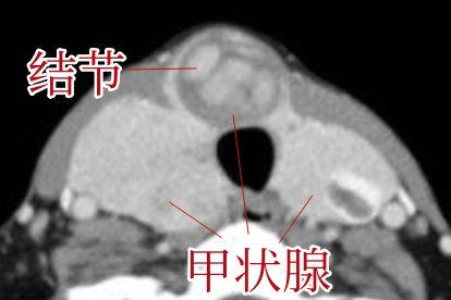 甲状腺ct图片