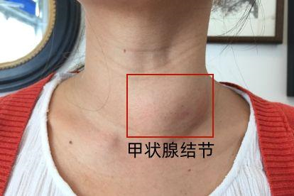 甲状腺结节脖子变粗图