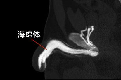 海绵体造影图片