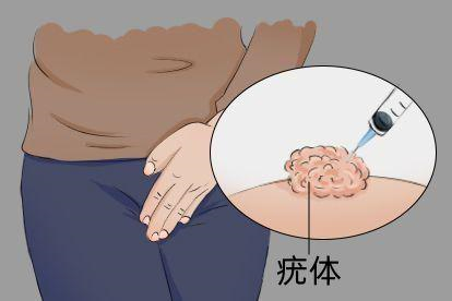 尖锐湿疣打封闭针图片