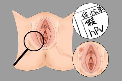 假性湿疣图片