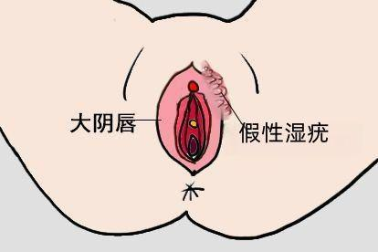 女性假性湿疣症状图
